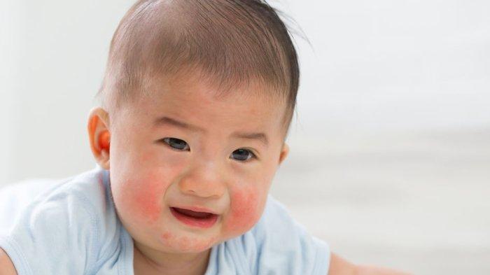 Ilustrasi bayi yang mengalami iritasi kulit, berikut cara mudah untuk mencegahnya