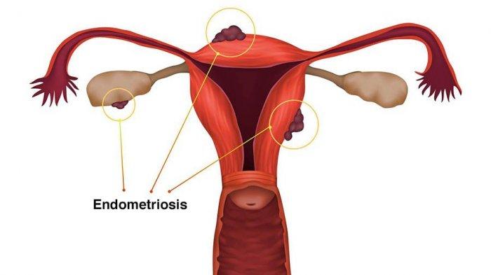 Endometriosis Apakah akan Berdampak Buruk bagi Kesehatan Dok?