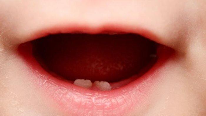 drg. Anastasia Paparkan Kronologis Keterlambatan Erupsi Gigi pada Anak