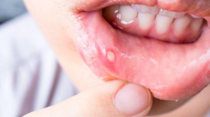 Jenis-jenis Stomatitis Aphtosa Rekuren yang Lebih Sering Menyerang Perempuan, Simak Ulasan Dokter