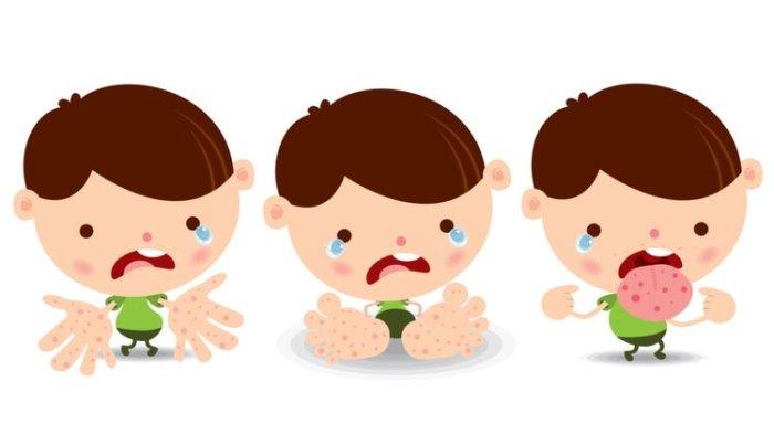 Ilustrasi flu Singapura yang banyak diderita anak-anak, berikut penjelasan Dokter Anak mengenai flu Singapura