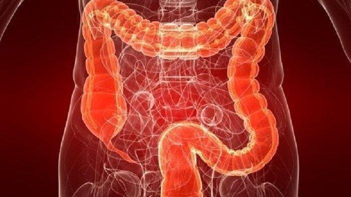 Ilustrasi gejala usus buntu yang biasa dirasakan pasien