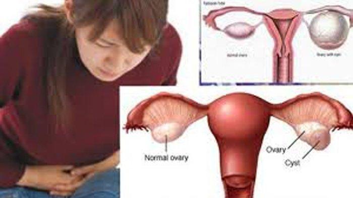 Dokter Jelaskan Hubungan Mioma Uteri dengan Masalah Kesuburan
