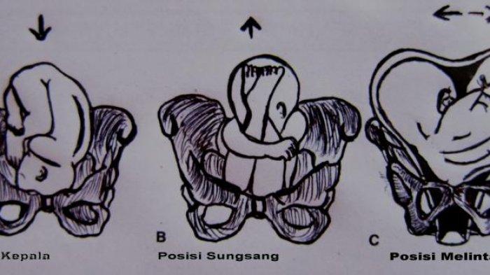 Dok, Apa yang Dapat Dilakukan Ibu Hamil Agar Bayi Tidak Sungsang saat Persalinan?