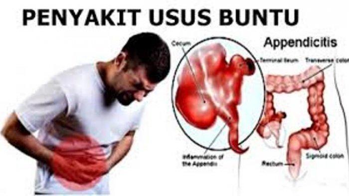 Waspada Gejala Radang Usus Buntu Agar Terhindar dari Penyakit Ini