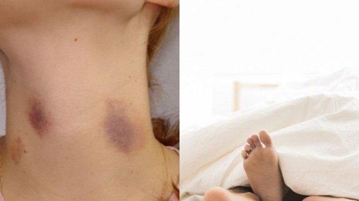 Viral, Seorang Gadis Tewas setelah Mendapat Ciuman 'Cupang' dari Pacar, Fakta Terungkap dalam Otopsi