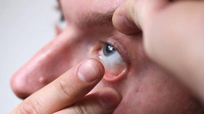 Jangan Menggunakan Softlens Kadaluwarsa, Dokter Spesialis Mata Mengatakan Bisa Merusak Kornea