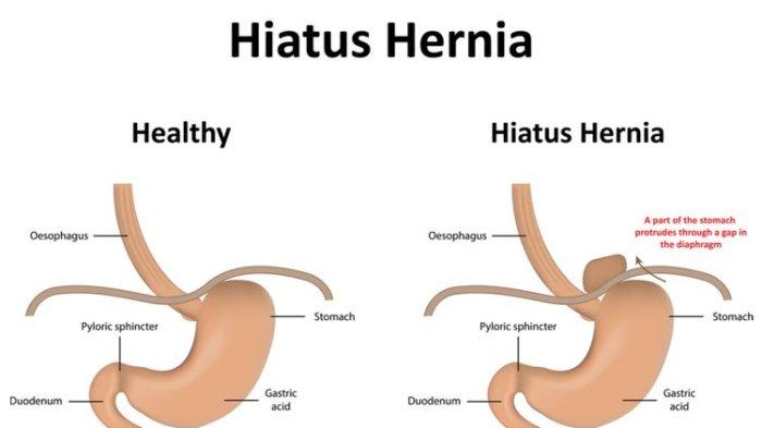 Benarkah Konstipasi Bisa Berujung Hernia? Begini Tanggapan dr. Muhammad Singgih Nugraha, Sp.B