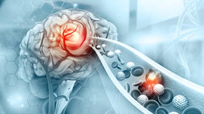 Ilustrasi terjadinya stroke pada kaum muda