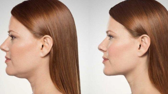 Double Chin Bisa Dipengaruhi Pembengkakan Kelenjar Getah Bening? Simak Penuturan dr. Caryn