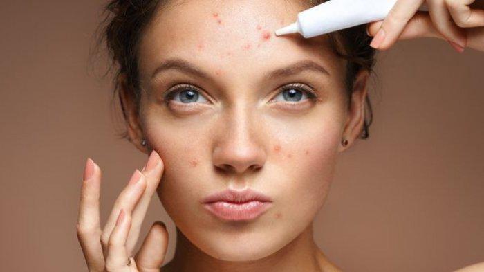 ilustrasi obat jerawat yang mengandung retinol