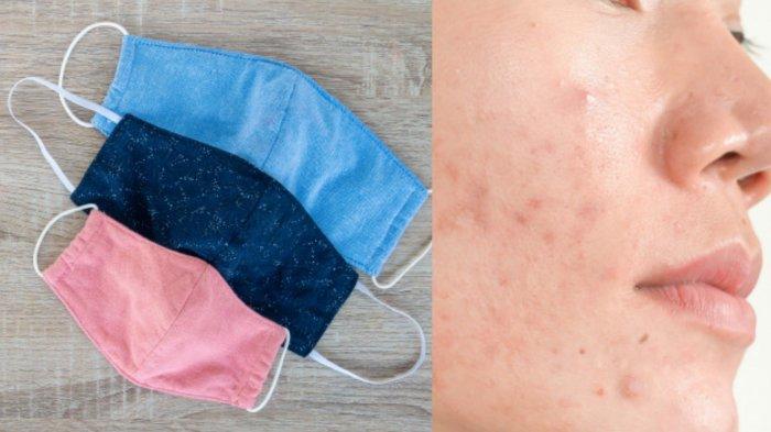 Munculnya Jerawat Bisa Disebabkan oleh Penggunaan Masker Terlalu Lama