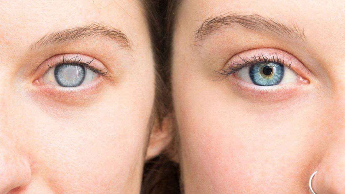 Lensa yang Digunakan Penderita Katarak, Apakah Softlens? Begini Penjelasan dr. Naziya Sp.M