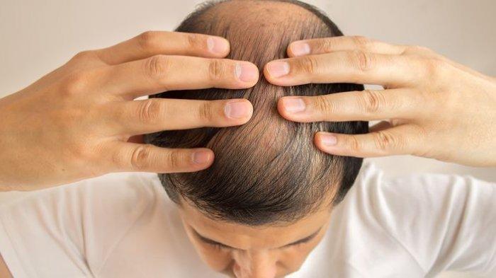 Kebotakan yang Terjadi Akibat Kerontokan Rambut Bisa Terjadi Sementara Ataupun Permanen