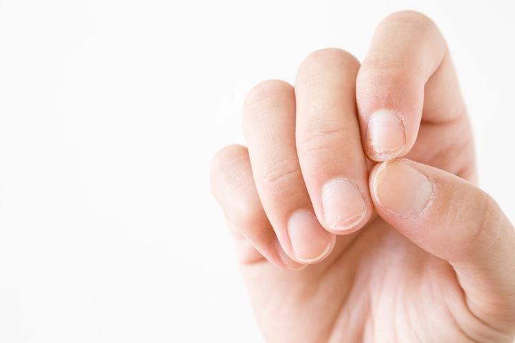 ilustrasi kuku bermasalah karena kurang vitamin C