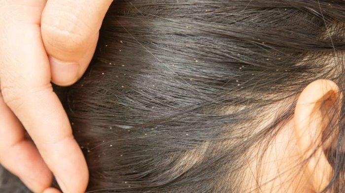 ilustrasi anak yang mengalami masalah kutu rambut, berikut cara alami untuk mengatasinya