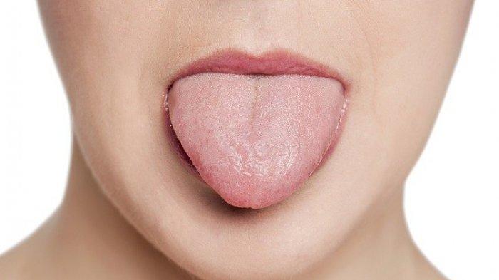 Faktor Risiko Defisiensi Vitamin B12, Gejala Bisa Diamati dari Kondisi Lidah