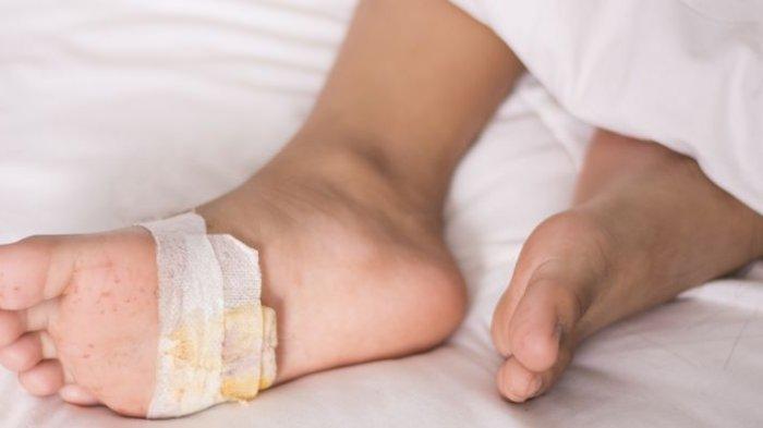 ilustrasi luka diabetes pada telapak kaki