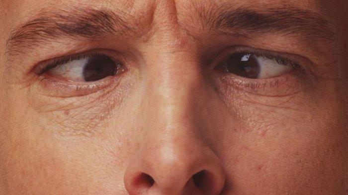 Menurunnya Penglihatan yang Diakibatkan oleh Mata Malas: Amblyopia