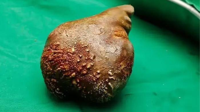 Batu Ginjal Pria Ini Lebih Besar dari Ginjalnya Sendiri, Anehnya Masih Tetap Berfungsi Normal