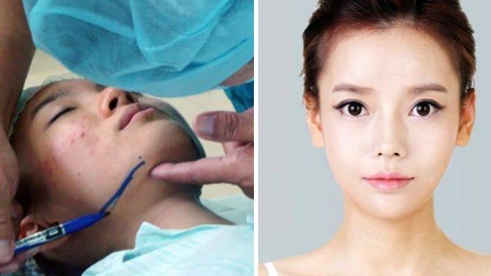 Cedera Wajah Akibat Trauma atau Kecelakaan bisa Diatasi dengan Rekonstruksi Rahang?