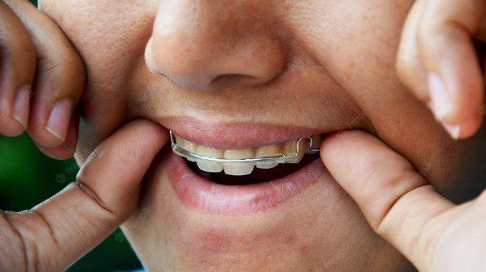 Berapa Lama Waktu yang Dibutuhkan dalam Penggunaan Retainer? Ini Penjelasan Dokter