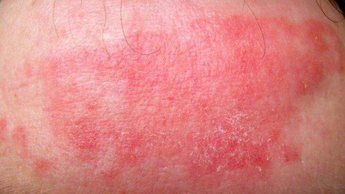Kenali Penyebab Rosacea, Keluhan pada Kulit Wajah yang Sering Dialami Wanita