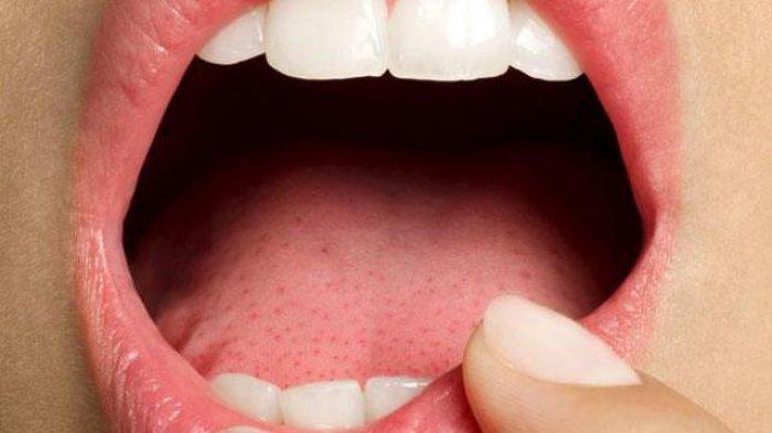 Mengapa Sariawan Tidak Kunjung Sembuh Dikaitkan Kurang Vitamin C? Begini Ulasan Dr. drg. Eddy