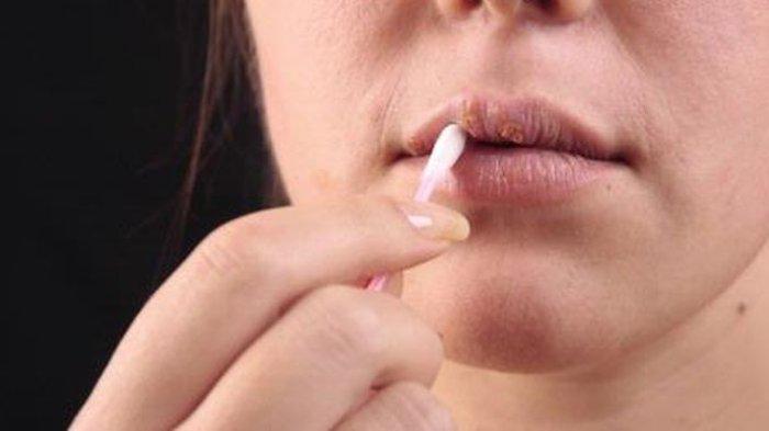 Dr. drg. Eddy Heriyanto Sebut Sariawan Tak Kunjung Sembuh Bisa Diakibatkan karena Kurang Vitamin C