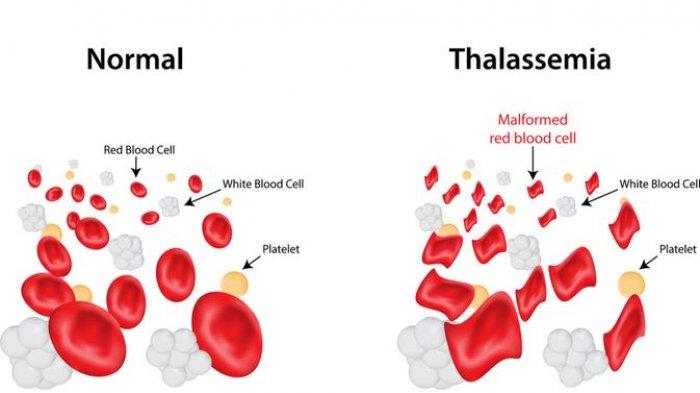 Apa yang Menjadi Penyebab Sel Darah Merah Penderita Thalasemi Mudah Hancur? Simak Ulasan Dokter