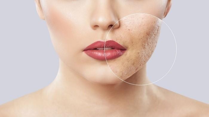 ilustrasi seseorang yang mengalami masalah kerusakan skin barrier, berikut penjelasan Dokter Spesialis Dermatologi, Venerologi, dan Estetika