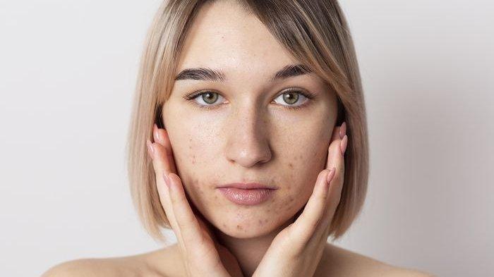 ilustrasi seseorang yang mengalami kerusakan pada skin barriernya, berikut penjelasan Dokter Dermatologi mengenai skin barrier