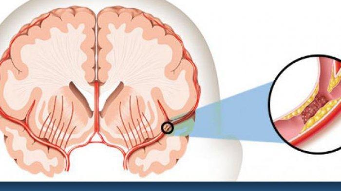 Seperti Apa Stroke yang Terjadi Ditengah Pandemi Covid-19 Dok?