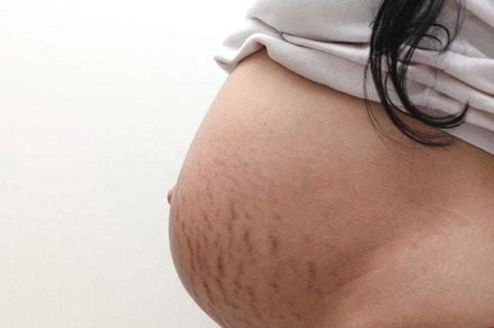 ilustrasi ibu hamil yang muncul stretch mark pada area perut
