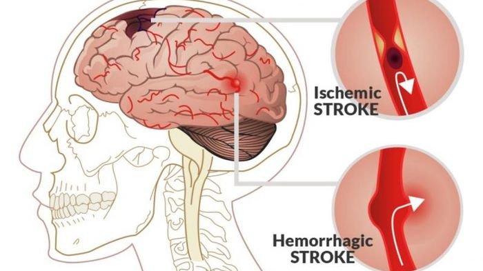 dr. Fahrulsyah Farid, Sp.BS. Sebut Usia Ini Perlu Waspada karena Rentan Menderita Penyakit Stroke