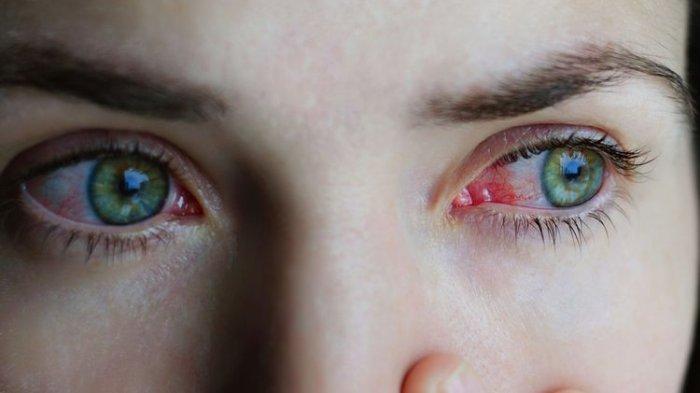 Pasien dengan Keratitis, Bisakah Dicegah Agar Tidak Terjadi Ulkus Kornea?