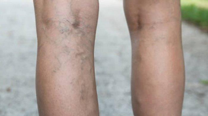 Mengenal Varises, Pembuluh Darah Berukuran Besar dan Berbentuk seperti Jaring Laba-laba