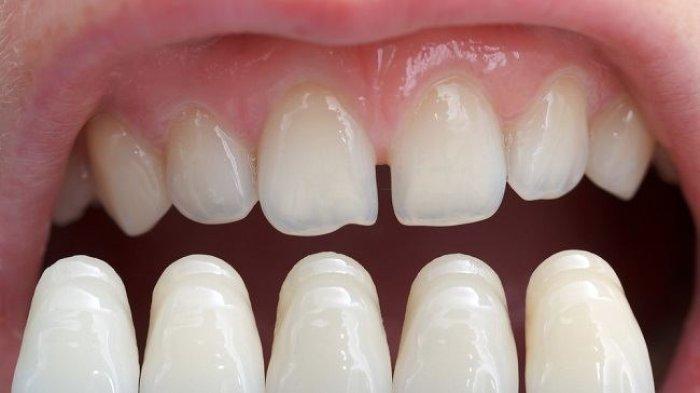 Masalah Gigi Berwarna yang Tidak Dapat Diatasi dengan Bleaching, Sangat Disarankan untuk Veneer