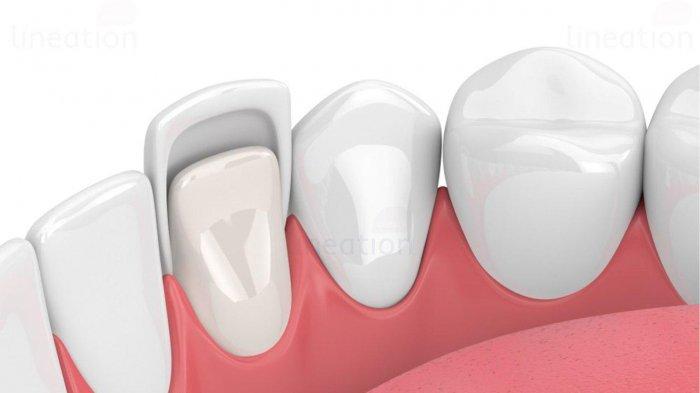 Ketahui Perbedaan Veneer Sementara dan Veneer Permanen Menurut drg. Irfan Dammar, Sp.Pros