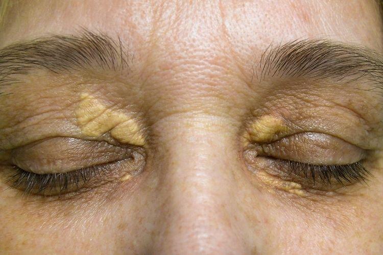ilustrasi xanthelasma