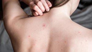 ilustrasi-back-acne-atau-jerawat-punggung-yang-mengganggu-penampilan.jpg