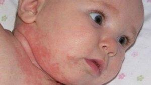 iritasi-kulit-bayi-3.jpg