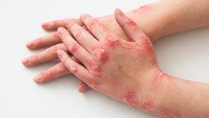 psoriasis-53723.jpg