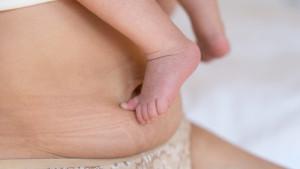 stretch-mark-10.jpg