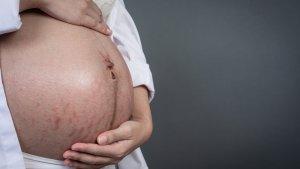 stretch-mark-8.jpg