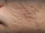 acne-scar-1.jpg