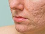 acne-scar.jpg