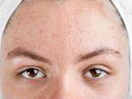 acne-vulgaris.jpg