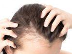 alopecia-1.jpg