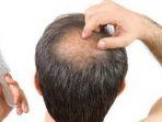 alopecia-9.jpg